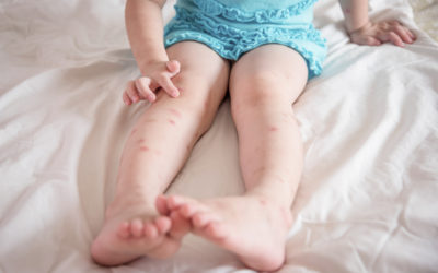 Bébé piqué par une punaise de lit, les symptômes et les traitements que tous Les parents devraient connaître